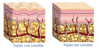 piel celulitis