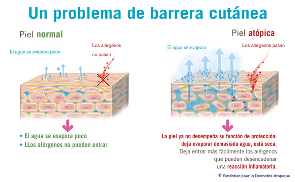 que-es-el-eccema-atopico-barrera-cutanea